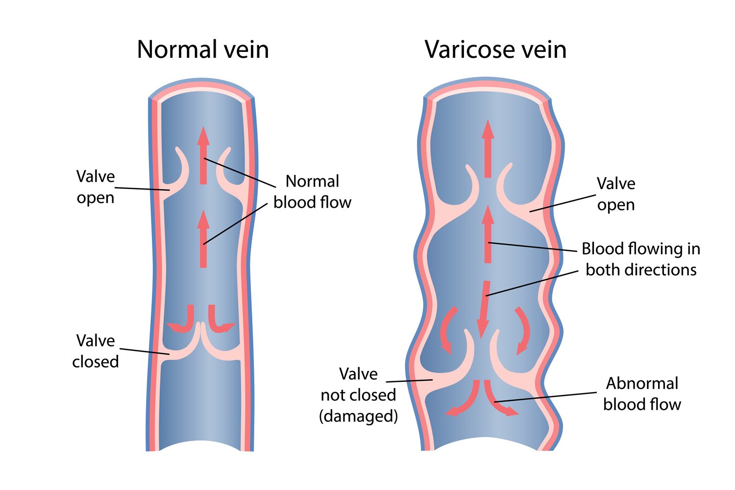 Why varicose veins happen